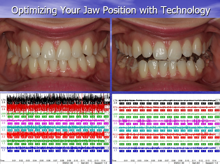 TMJ precision photo